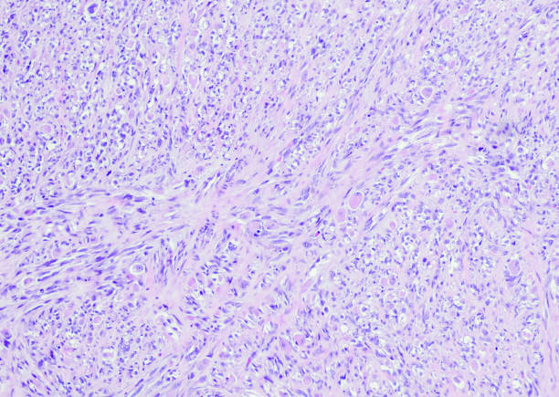 60+ Rhabdomyosarcoma Stock Photos, Pictures & Royalty-Free Images - iStock