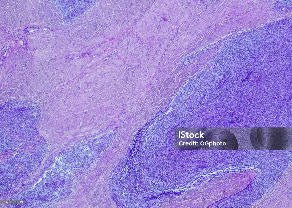 Low-grade endometrial stromal sarcoma Low-grade endometrial stromal sarcoma, Site: Uterus Anatomy Stock Photo