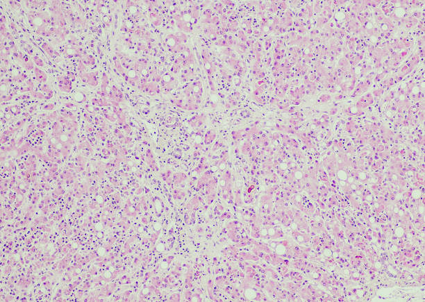 istock Steatohepatitis with cholestasis and fibrosis, alcohol related 1409391016