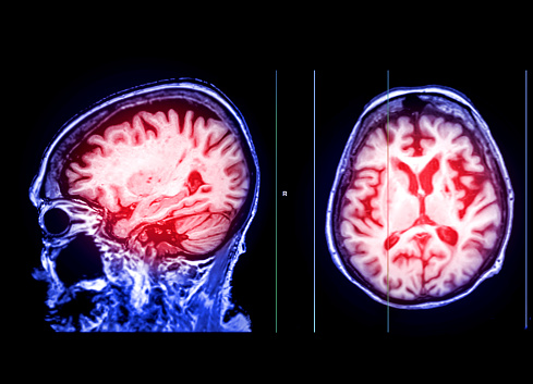 MRI brain sagittal and Axial  T2 flair technique  for detect a variety of conditions of the brain such as cysts, tumors, bleeding and stroke diseases.