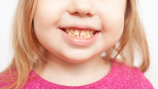 la persona sonríe, muestra dientes, placa amarilla, dientes torcidos, maloclusión. niñez photo