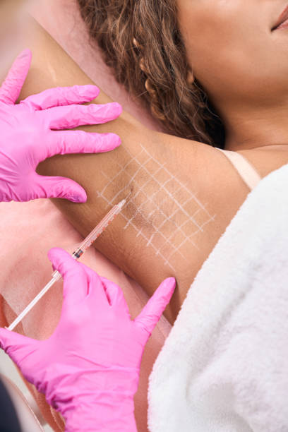 Botulinum toxin injections in the armpits for the problem of hyperhidrosis Female patient with hyperhidrosis problem receiving botulinum toxin injections in armpits in cosmetology clinic sweat gland stock pictures, royalty-free photos & images