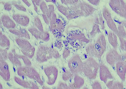 Chronic bronchitis under microscopy zoom in different areas