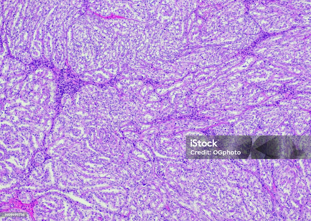 Mucinous tubular and spindle cell carcinoma Mucinous tubular and spindle cell carcinoma. Site: Kidney: Mucinous tubular and spindle cell carcinomas are rare kidney tumors with generally indolent behavior. As the name suggests, classic histomorphology reveals bland spindle cells, tubules, and mucinous stroma. Anatomy Stock Photo