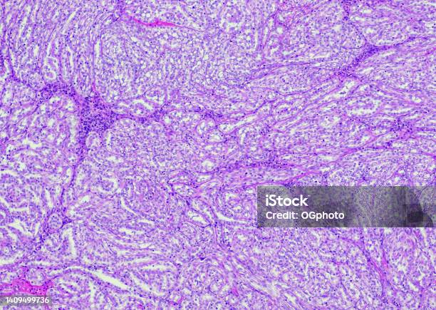Mucinous Tubular And Spindle Cell Carcinoma Stock Photo - Download Image Now - Anatomy, Backgrounds, Biological Cell