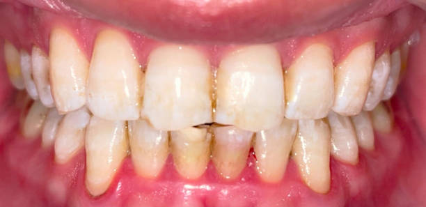 istock Close Up To Teeth Whitening 1409520886