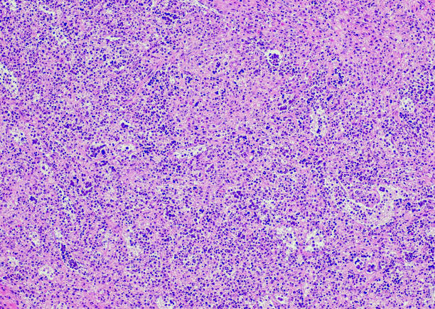 linfoma di hodgkin classico, sottotipo di cellularità mista. luogo: spleen.  la cellularità mista è un sottotipo di linfoma di hodgkin classico caratterizzato da cellule diagnostiche di hodgkin-reed sternberg in un back-ground infiammatorio misto senza  - hodgkins disease foto e immagini stock