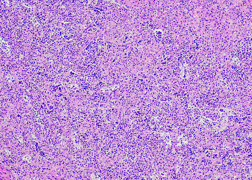 Classical Hodgkin lymphoma, mixed cellularity subtype. Mixed cellularity is a subtype of classical Hodgkin lymphoma characterized by diagnostic Hodgkin-Reed Sternberg cells in a mixed inflammatory back-ground without sclerosis. Mononuclear Hodgkin cells can be present. The mixed cellular background is considered the hallmark of the Mixed cellularity classical Hodgkin lymphoma subtype.