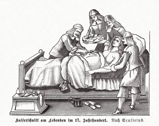Caesarean section (17th century), wood engraving, published in 1891 vector art illustration