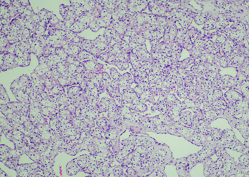 Clear cell renal cell carcinoma. Site: Kidney. Clear cell renal cell carcinoma is a cancer of the kidney. The name \