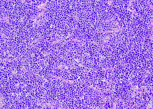 Diffuse large B-cell lymphoma, germinal center B-cell like. Site: Small cell mesentery. Diffuse large B-cell lymphoma (DLBCL) is an aggressive but extremely heterogeneous group of lymphomas.