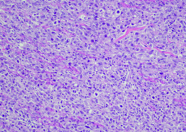 Lymphoproliferative disorder (Epstein Barr virus (EBV) positive large B-cell lymphoma). Site: Terminal ileum and ascending colon. (EBV+ DLBCL) of the elderly is a rare B-cell lymphoproliferative disorder (B-LPD) that occurs in patients > 50 years with no Lymphoproliferative disorder (Epstein Barr virus (EBV) positive large B-cell lymphoma). Site: Terminal ileum and ascending colon. (EBV+ DLBCL) of the elderly is a rare B-cell lymphoproliferative disorder (B-LPD) that occurs in patients > 50 years with no known history of immunodeficiency or lymphoma. epstein barr virus photos stock pictures, royalty-free photos & images