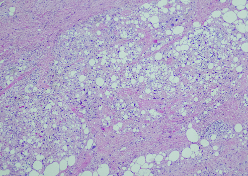 Pleomorphic liposarcoma. Site: Neck. Pleomorphic liposarcoma is a rare subtype of fat cell cancer in the body. It is a rare and very malignant type of tumor that usually arises from fat cells and deep soft tissues of the upper and lower extremities (shoulder, arms, legs, and thighs).