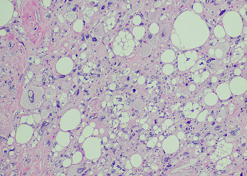 Pleomorphic liposarcoma. Site: Neck. Pleomorphic liposarcoma is a rare subtype of fat cell cancer in the body. It is a rare and very malignant type of tumor that usually arises from fat cells and deep soft tissues of the upper and lower extremities (shoulder, arms, legs, and thighs).