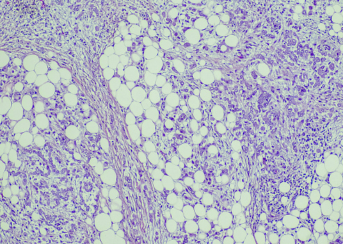 Diffuse epithelioid malignant mesothelioma. Site: Peritoneum.  Diffuse epithelioid mesothelioma affects the lining of the organs, including the lungs, stomach, or heart.