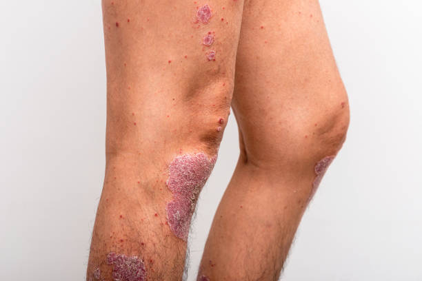istock Psoriasis is that knee on white background. 1409632156
