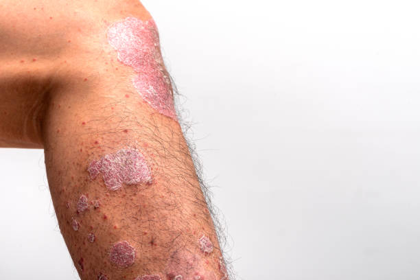 istock Psoriasis is that knee on white background. 1409632959