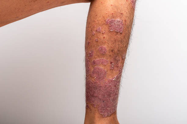 istock Psoriasis is that knee on white background. 1409632975