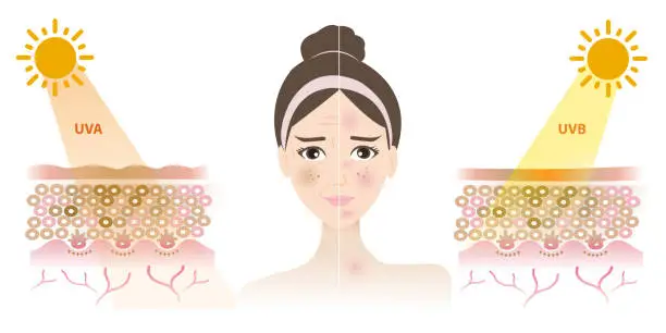 Vector illustration of Comparison of damaged skin face from UVA and UVB rays vector on white background.