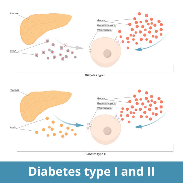 ilustraciones, imágenes clip art, dibujos animados e iconos de stock de diabetes tipo i y ii - síndrome metabólico