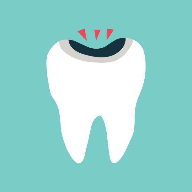 ilustraciones, imágenes clip art, dibujos animados e iconos de stock de diente dolorido con caries negra - filling