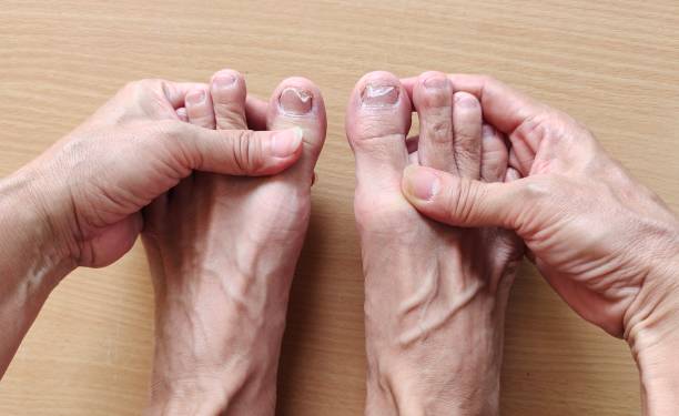 istock Dermatitis inflammation and Infection of toenails. 1409826209