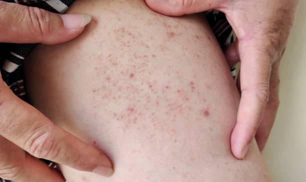 istock Papule allergy dermatitis inflammation on the leg. 1409976545