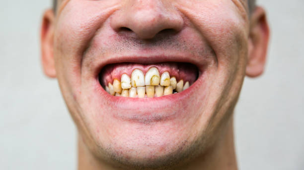 dientes de hombre malo. rellenos de cavidades de baja calidad. - hombre feo fotografías e imágenes de stock