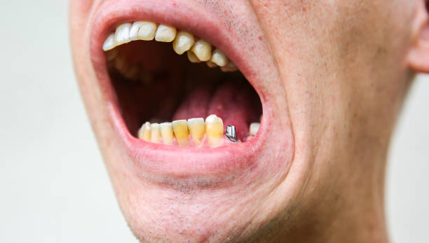 istock Teeth implantation. Dental post preparation. Medical problem. 1410061462