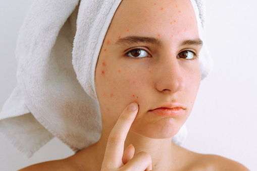Piel adolescente problemática, procedimiento cosmético para la limpieza de la piel facial, eliminación de manchas negras y granos photo