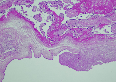 Amnion nodosum. Site: Placenta. Amnion nodosum are nodules found on the amnion, and is frequently present in oligohydramnios. The nodules are composed of squamous cell aggregates derived from the vernix caseosa on the fetal skin.