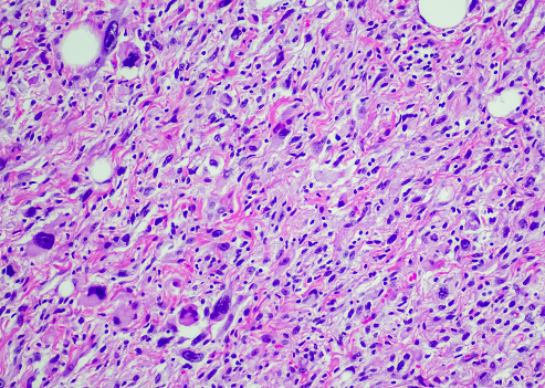 Dedifferentiated Liposarcomas are slow-growing, malignant soft tissue tumors. These tumors are typically present in the retroperitoneum (abdominal cavity) followed by the limbs