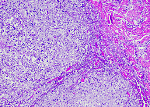 Metastatic melanoma. Site: Neck. Metastatic melanoma is a disease that occurs when the cancerous cells from the original tumor (primary tumor) get loose, spread by traveling through the lymph or blood circulation, and start a new tumor (metastatic tumor) somewhere else.