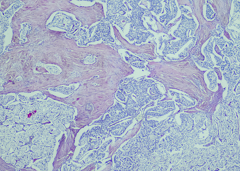 Pancreatic neuroendocrine tumor, clear cell variant. Site: Pancreas.