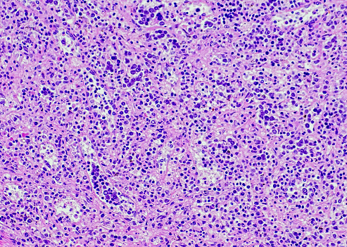 Kidney cancer, sample collected by CT guided FNA from renal mass. Micrograph of small cell carcinoma, show granular salt-pepper chromatin, background inflammatory cells and blood, selective focus