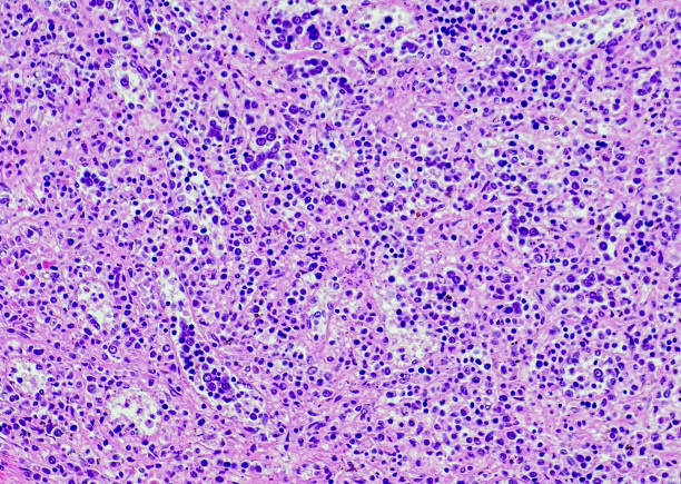 Primary myelofibrosis with extramedullary hematopoiesis. stock photo