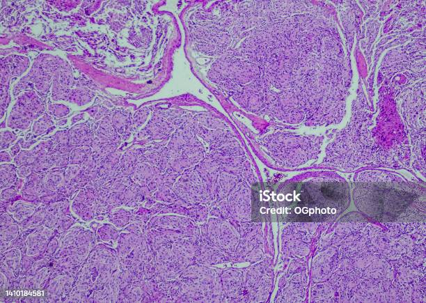 Who Grade I Meningioma Stock Photo - Download Image Now - Brain, Brain Tumour, Histology