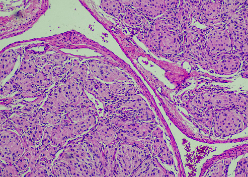 Mesothelioma cancer disease concept as human lungs with growing malignant cancer cells as a medical illness conceptual symbol for asbestos exposure in a 3D illustration style.