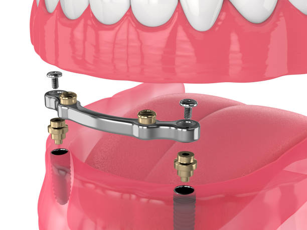 istock 3d render of bar retained removable overdenture installation supported by two implants 1410219110