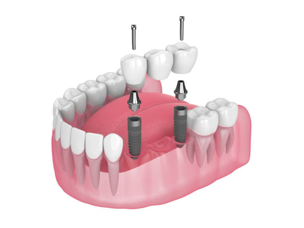 istock 3d render of jaw with dental bridge supported by implants over white 1410219114
