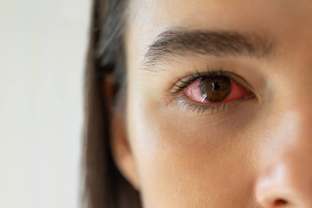 istock Red bloodshot eye 1410235228