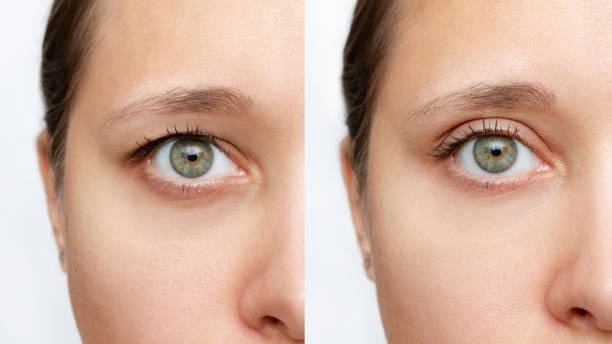 istock Young caucasian woman's face with drooping upper eyelid before and after blepharoplasty 1410298104