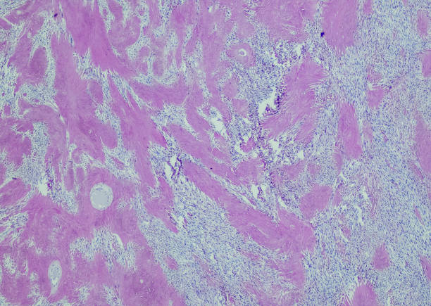 fibroide - ovary human cell cell high scale magnification fotografías e imágenes de stock
