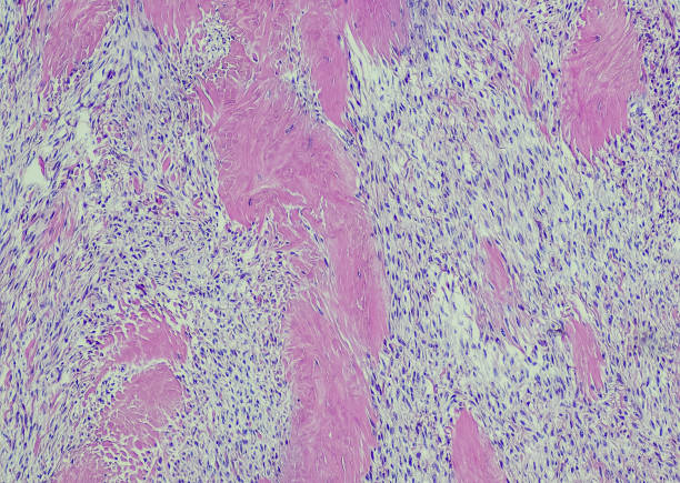 fibroide - ovary human cell cell high scale magnification fotografías e imágenes de stock