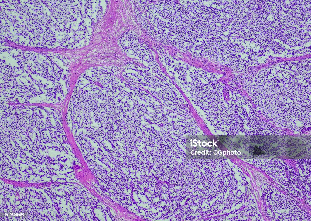 Seminoma Seminoma. Site: Testis. A type of cancer that begins in germ cells in males. Germ cells are cells that form sperm in males or eggs in females. Seminomas occur most often in the testicle. Anatomy Stock Photo