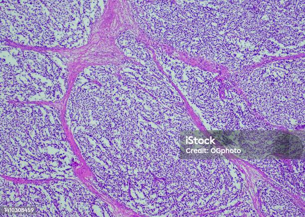 Seminoma Stock Photo - Download Image Now - Anatomy, Backgrounds, Biological Cell
