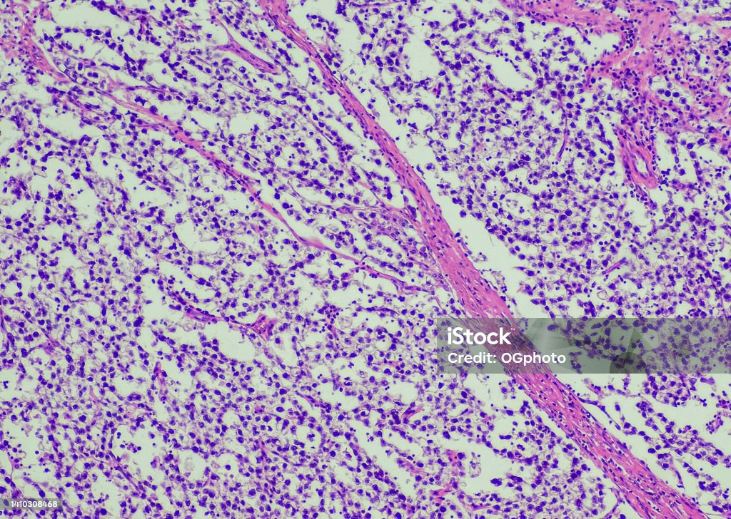 Seminoma Seminoma. Site: Testis. A type of cancer that begins in germ cells in males. Germ cells are cells that form sperm in males or eggs in females. Seminomas occur most often in the testicle. Biological Cell Stock Photo