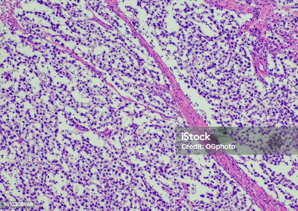 Seminoma Stock Photo - Download Image Now - Biological Cell, Anatomy, Backgrounds