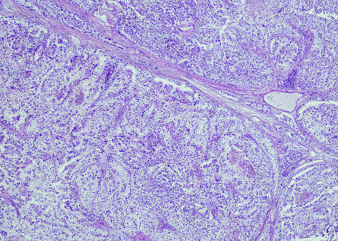 TFE3-associated renal cell carcinoma. Site: Kidney. TFE3 and TFEB belong to the MiT family, which regulates melanocyte and osteoclast differentiation, and TFE3- and TFEB-rearranged RCC show characteristic clinicopathological and immunohistochemical features.