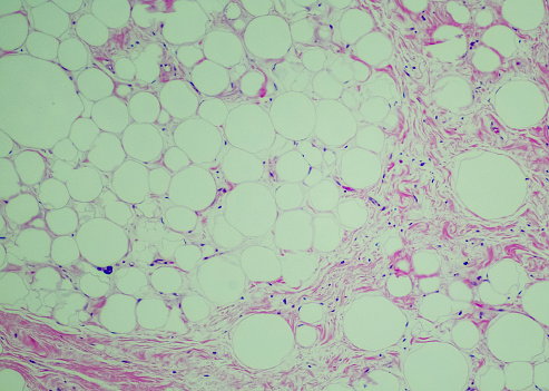 Well-differentiated liposarcoma. Site: Retroperitoneum. Well-differentiated liposarcoma is the most common form. It grows slowly and generally does not spread to other parts of the body.